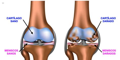 Artrosis de Rodilla: qué es, síntomas y tratamiento | Top Doctors