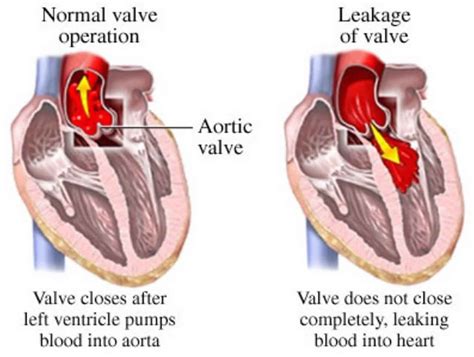 Bounding pulse definition, causes, diagnosis & treatment