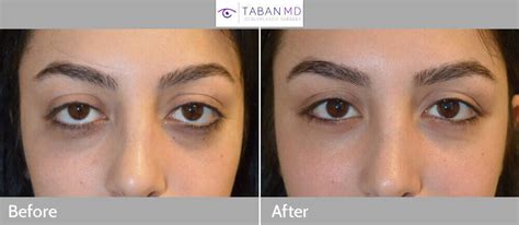 Graves Disease Before and After Gallery | Taban MD