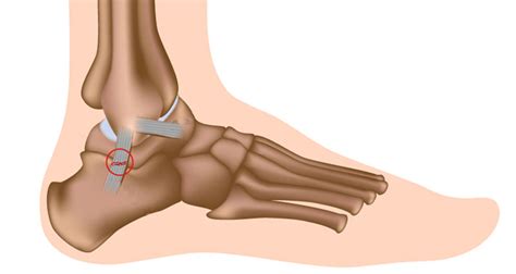 Sprained Ankle - Treatment, Rehabilitation & Exercises