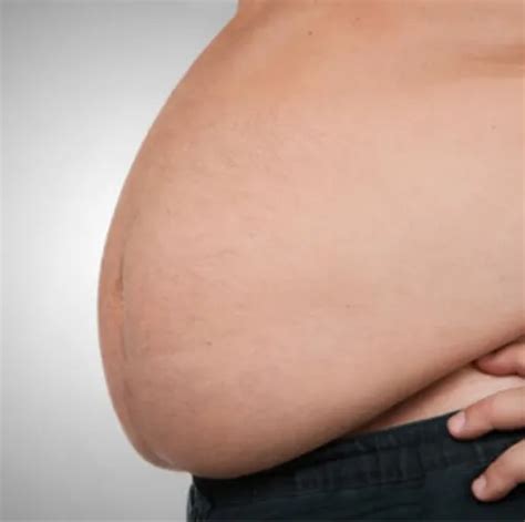 Morbid Obesity Treatment Service in Noida by Dr Saurabh Bansal Laparsocpic Gastro Surgery | ID ...