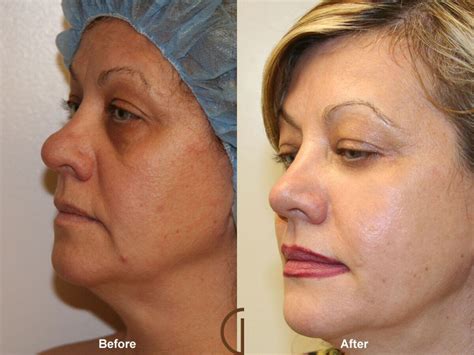 Facial Fat Grafting Before & After Photos Patient 03 | Dr Kevin Sadati