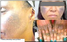 We are scarred and burnt for life –Users of bleaching creams cry out ...