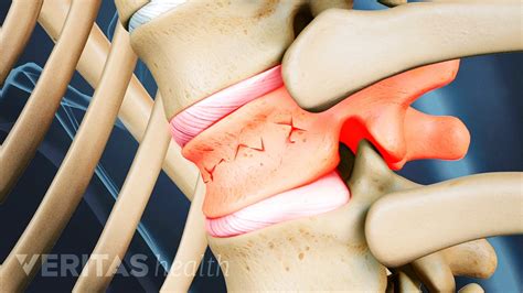 Wedge In Spine