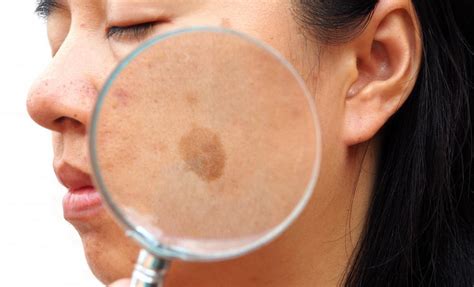 Common Causes of Melasma and What You Can Do About It: Rapaport Dermatology of Beverly Hills ...