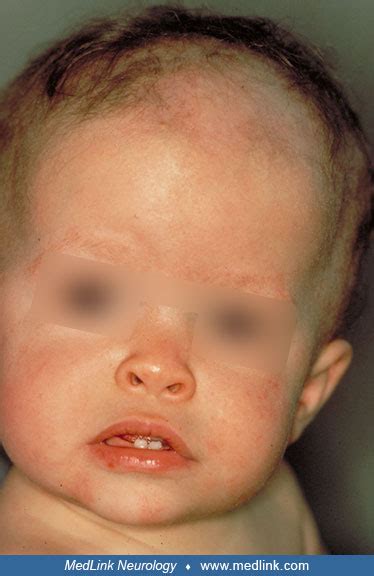 Chondrodysplasia punctata | MedLink Neurology