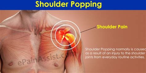 Shoulder Popping - Why Does Pop?, Symptoms, Treatment