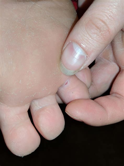 A small open wound on the seam of my toe, should i be worried? : r/medical