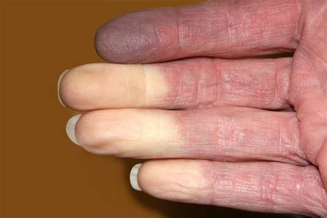 Raynaud's disease - myDr.com.au