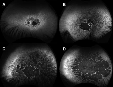 Cone/Cone-rod dystrophy: for professionals - Gene Vision