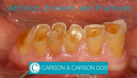 Tooth Abrasion Vs Erosion