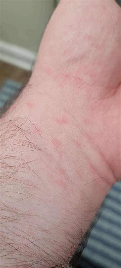 Hives? Allergy? Red spots on Wrists/Hands. : r/medical_advice