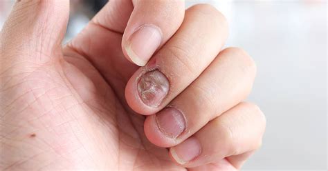 Treating Fungal Nail Infections: Tips From A Singapore Dermatologist