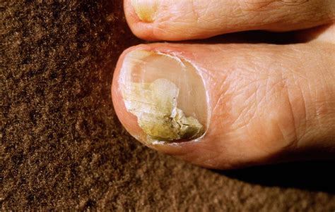 toenail fungus vinegar and peroxide - Toenail Fungus Treatment | Toenail Fungus Treatment