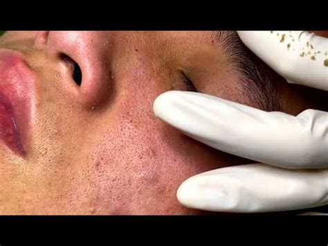 Enilsa Brown - Blackhead Extractions "K" 2nd Treatment