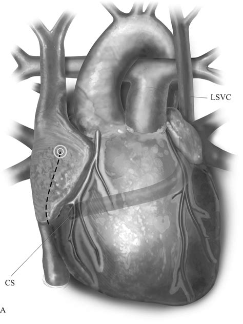 Heart Transplant: Transplantation for Congenital Heart Disease - Operative Techniques in ...