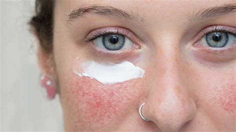 Treating rosacea on the face | Spot Check: skin cancer + aesthetics. Melbourne CBD