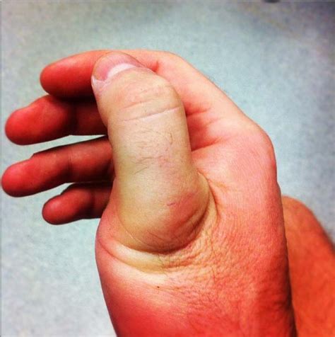 Finger Dislocation Know Symptoms Causes Diagnosis Way - vrogue.co