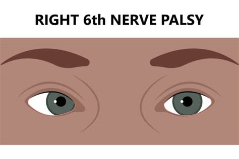 Cranial Nerve Palsy – CN III, IV, VI & VII Palsy