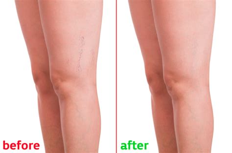 Do Spider Vein Removal Treatments Work | Toronto Laser Clinic