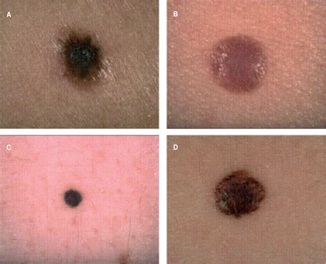 Small Nodular Melanoma: The Beginning of a Life-Threatening Lesion. A Clinical Study on 11 Cases ...