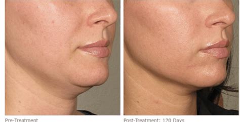 4 Non-Surgical Neck Lift Alternatives | The Worley Gig