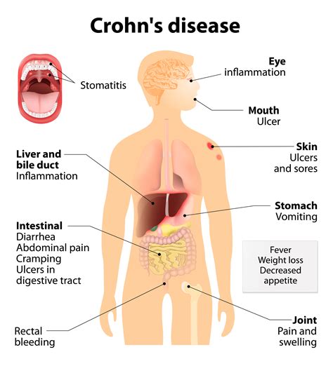 Crohn's Disease Treatment - Garden City, NY - East Setauket, NY