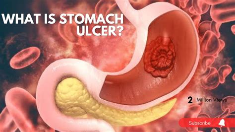 What is Stomach Ulcer?Causes of Stomach ulcer Treatment of Stomach Ulcer - YouTube