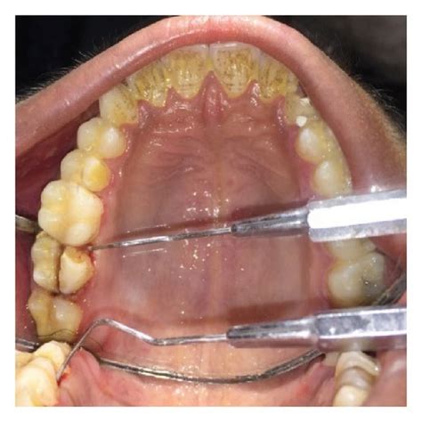 Preoperative photograph showing split tooth of 27. | Download Scientific Diagram