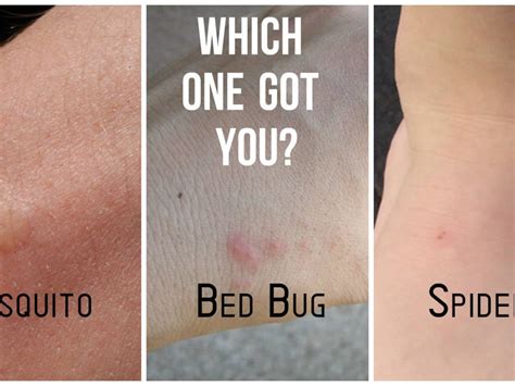 Can Bed Bug Bites Look Like Ringworm - PestPhobia