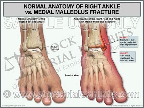 Ankle Anatomy Normal vs Medial Malleolus Fracture of Right Ankle, normal ankle vs medial ...