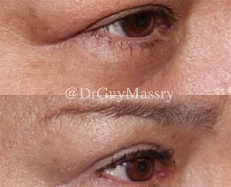 Lacrimal Gland Repair - Dr. Guy Massry