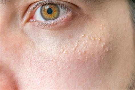 How To Get Rid Of Little Pimples - Considerationhire Doralutz