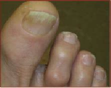 How To Treat Dystrophic Nails