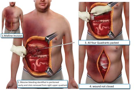 Laparotomy: Everything you need to know - Jalal Surgical