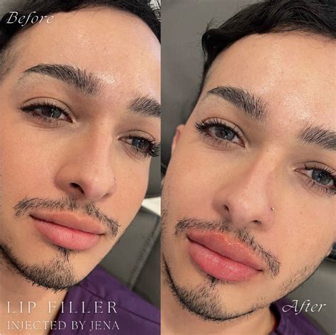 Difference Between Lip Fillers and Lip Flips!