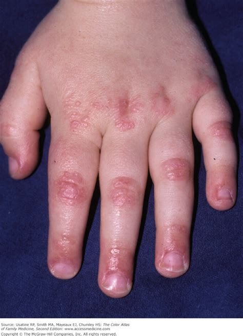 Dermatomyositis Rash On Hands