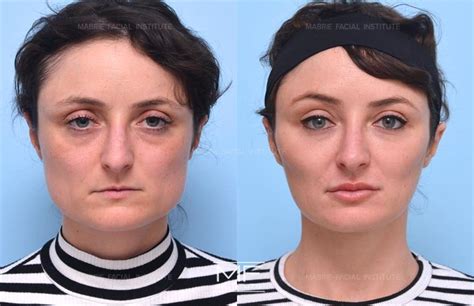 Jowls before And After Weight Loss 2024 : Transform Your Face Today - I'm Health Fit