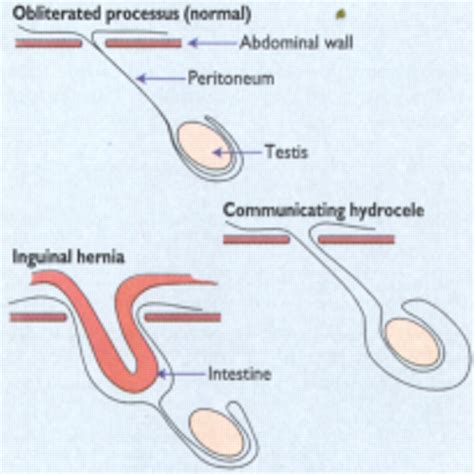 ABC of General Paediatric Surgery: INGUINAL HERNIA, HYDROCELE, AND THE UNDESCENDED TESTIS | The BMJ