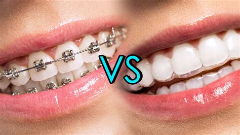 Metallic Braces VS Invisalign Braces - Whats best?! - Regent Dental UK