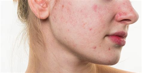 Acne Rosacea Treatment - Dermatology Consultants of South Florida