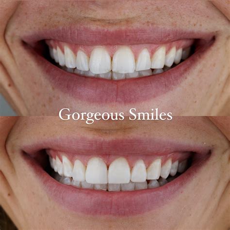 Dental Bonding Before And After Pictures - Gorgeous Smiles