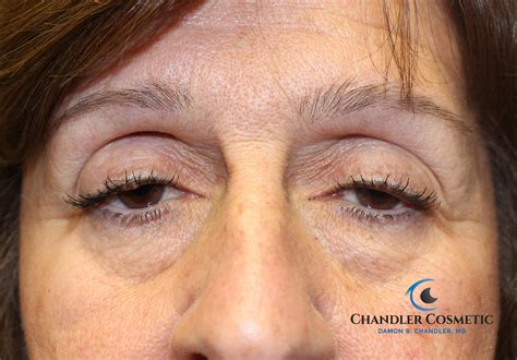 Ptosis Repair (Eyelid lift) for Droopy Eyelids - Chandler Cosmetic