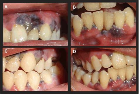 Necrotizing Ulcerative Gingivitis Before And After