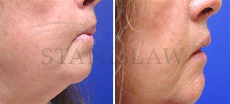 Lip Reconstruction Surgery Connecticut | Lip Repair Hartford