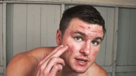 Bodybuilder with acne covering his whole face transformed his skin by giving up ONE thing - Real-Fix