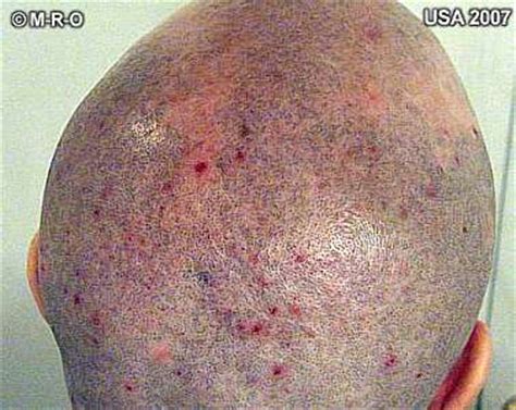 Morgellons skin symptoms