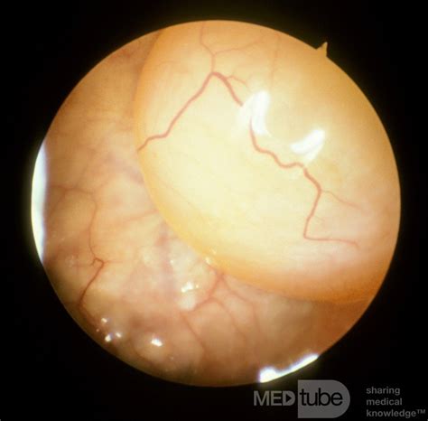 Maxillary Sinus Cyst [sinuscopic examination] • Picture • MEDtube.net