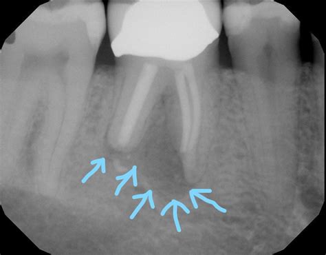 Fractured Root Canal - Extraction & Implant | Klahanie Family Dentistry