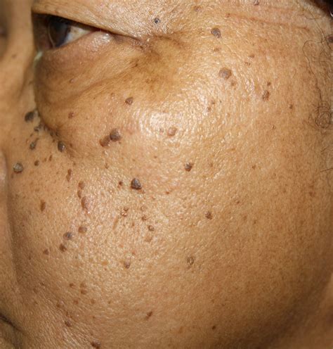 Dermatosis Papulosa Nigra Removal Before And After